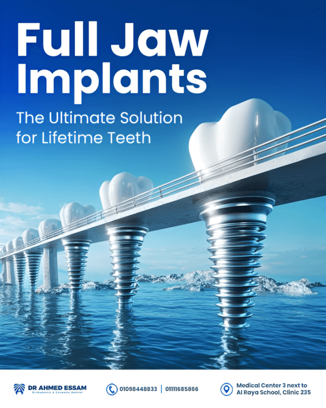 Full Jaw implant (1)
