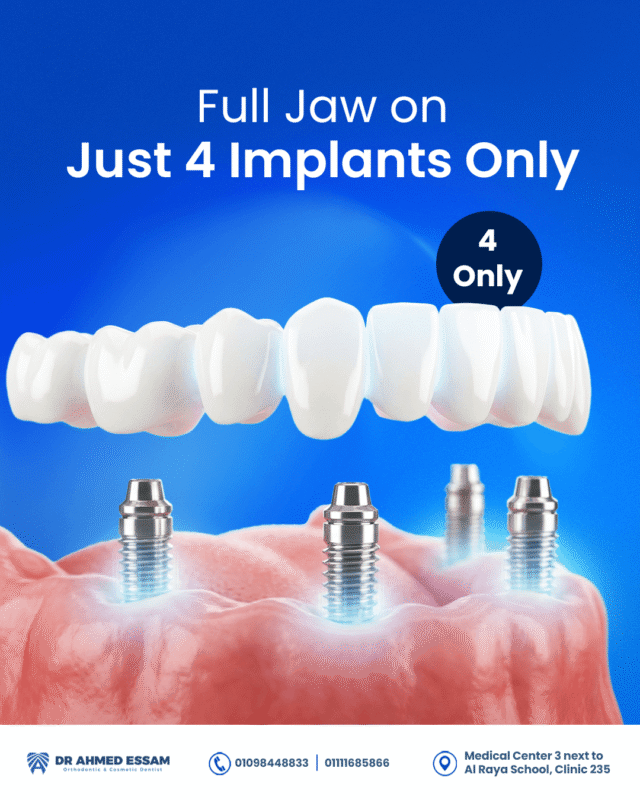 Full Jaw on